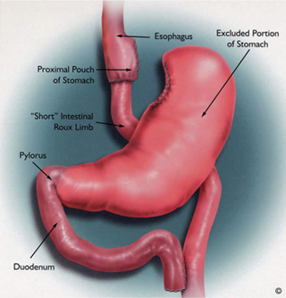 gastric bypass surgery