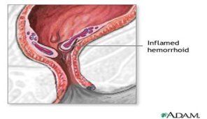 hemorrhoids